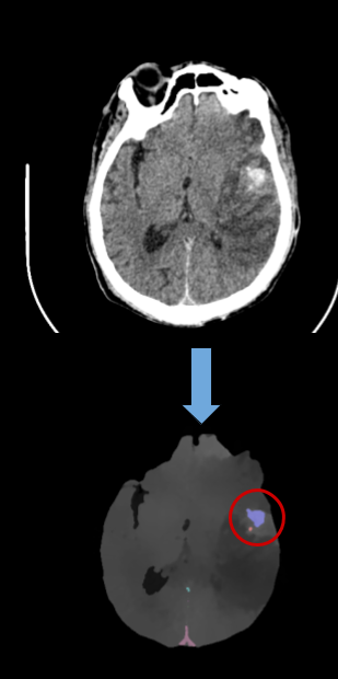 CT Detection